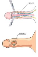배부신경차단술비용4