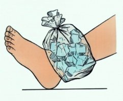 아킬레스건파열3