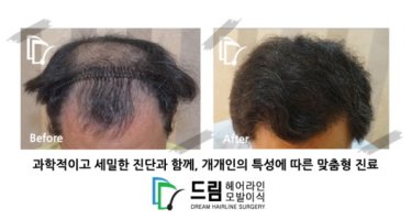 모발이식추천병원4