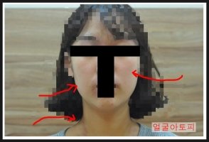 얼굴아토피5