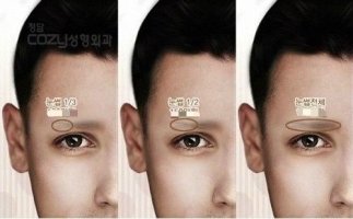 속눈썹이식수술비용6