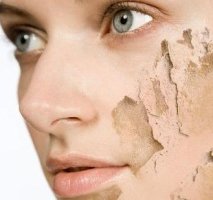 여드름레이저치료3