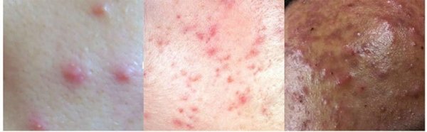 여드름빨간자국4