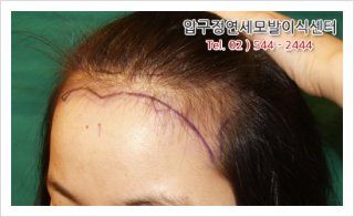 속눈썹이식수술비용2