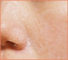 겟잇뷰티블랙헤드제거2