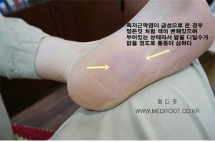 족저근막염깔창3