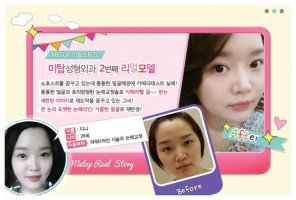 아큐스컬프붓기2