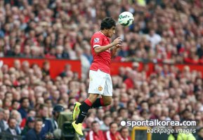 광대뼈골절수술1