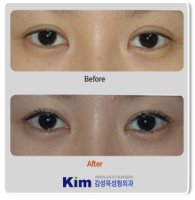 남자쌍꺼풀재수술1