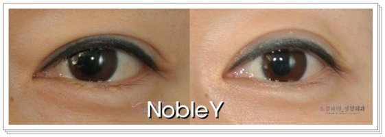 이마눈썹거상술4