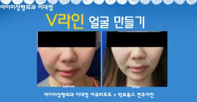 아큐스컬프붓기4