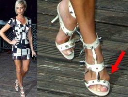 무지외반증교정5