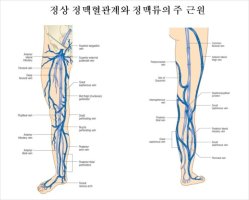 하지정맥류시술법2