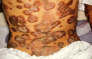 에이즈란 무엇인가? 에이즈의 감염경로 및 에이즈증상