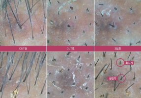 강남두피케어3