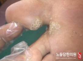 사마귀냉동치료3