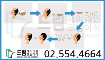 모발이식부작용2