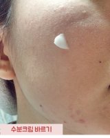여드름제품3