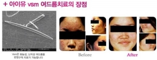 강남여드름치료1