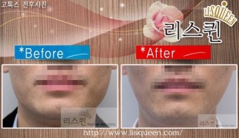 고톡스잘하는곳4