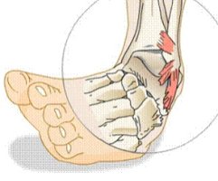 발목인대파열증상1