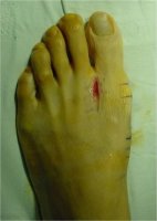 무지외반증교정6