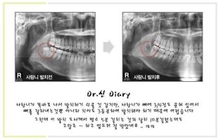 사랑니발치비용1