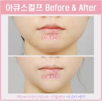 아큐스컬프붓기3