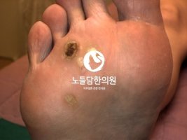 사마귀냉동치료2