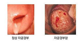 자궁경부암증상3