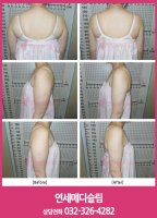 겨드랑이지방흡입4