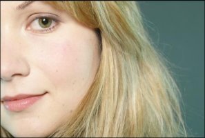 사마귀없애는방법1