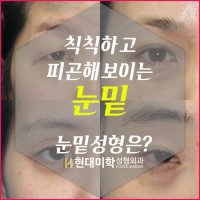 다크써클수술가격2
