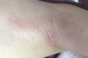 청주제모잘하는곳1