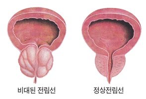 전립선비대증