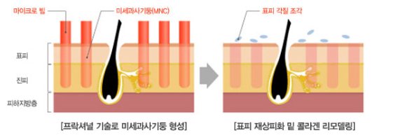 여드름빨간자국2