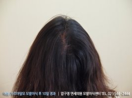 가르마모발이식3