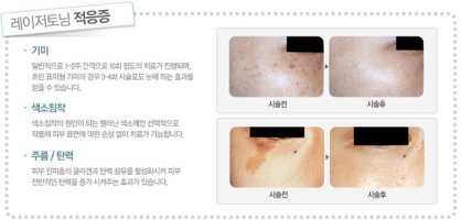 얼굴잡티제거가격1