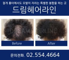 머리카락이식수술3