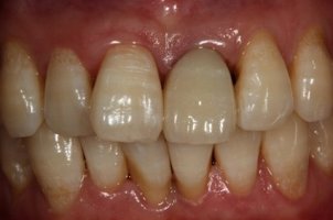 앞니인플란트가격2