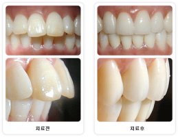 라미네이트연예인1