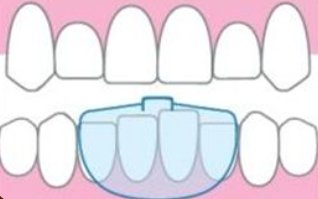 이갈이스플린트1