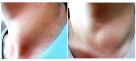 갑상선치료방법2