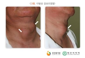 갑상선자가진단3