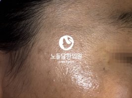 사마귀없애는방법4