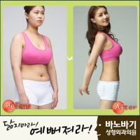 전신지방흡입비용2