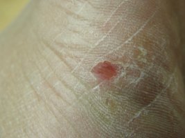 발가락사이무좀2